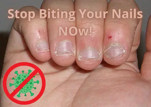the horrific effects of biting your nail