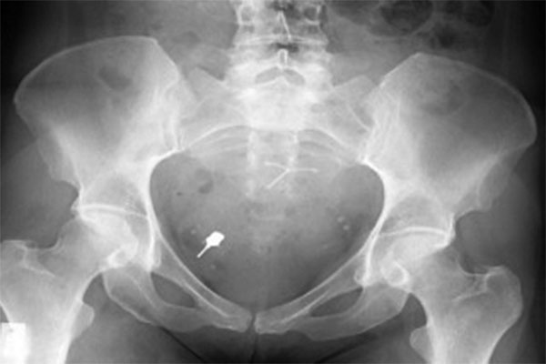 what happens if you swallow a small screw