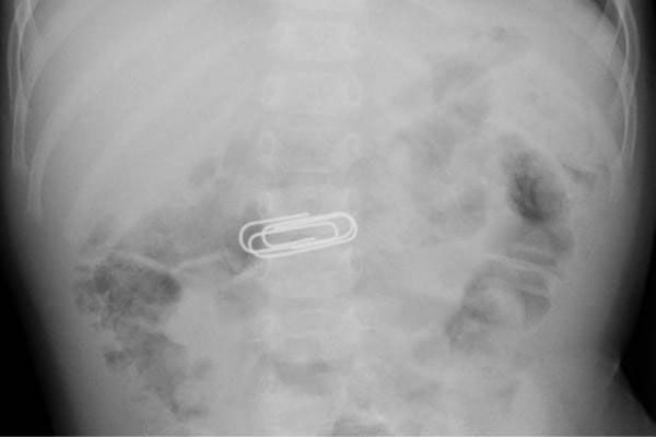 what happens if you swallow paper clip