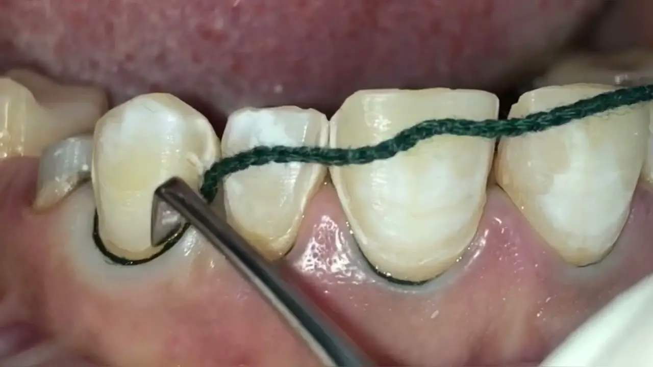 What Happens If Retraction Cord is Left